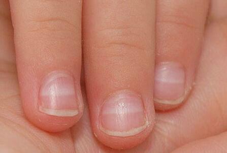 手指甲有白点暗示这4种疾病，很多人都不知道。