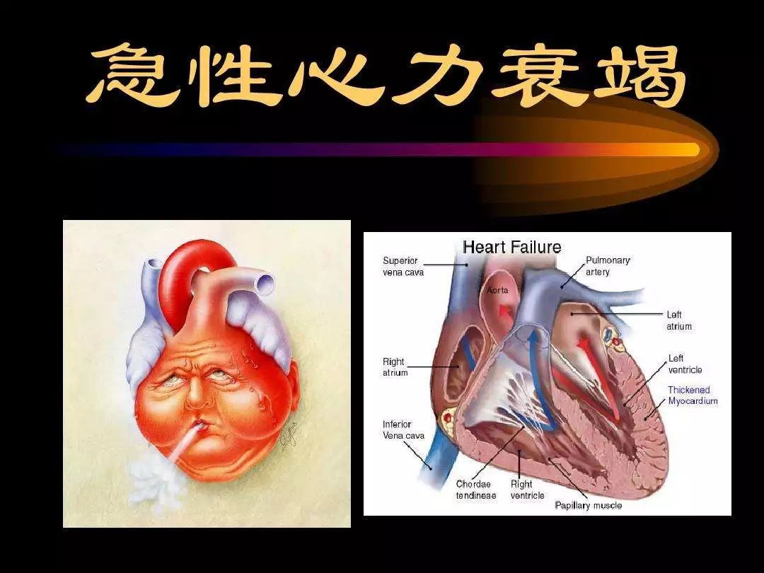 组织,器官灌注不足和心源性休克的临床综合征,以急性左心衰竭最为常见