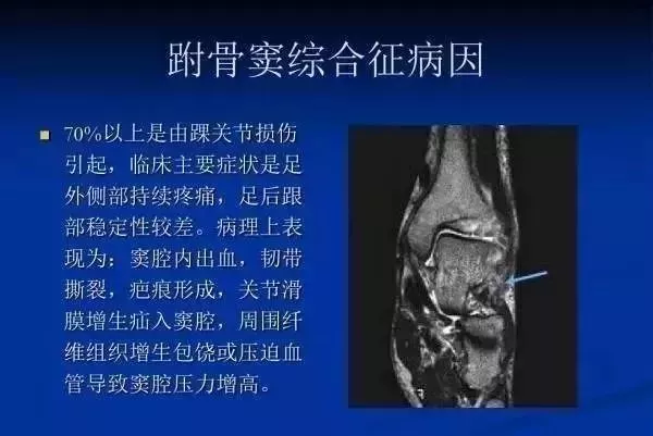 跗骨窦综合征关节镜手术入路!