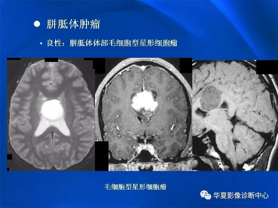 胼胝体解剖及各种病变的影像学表现