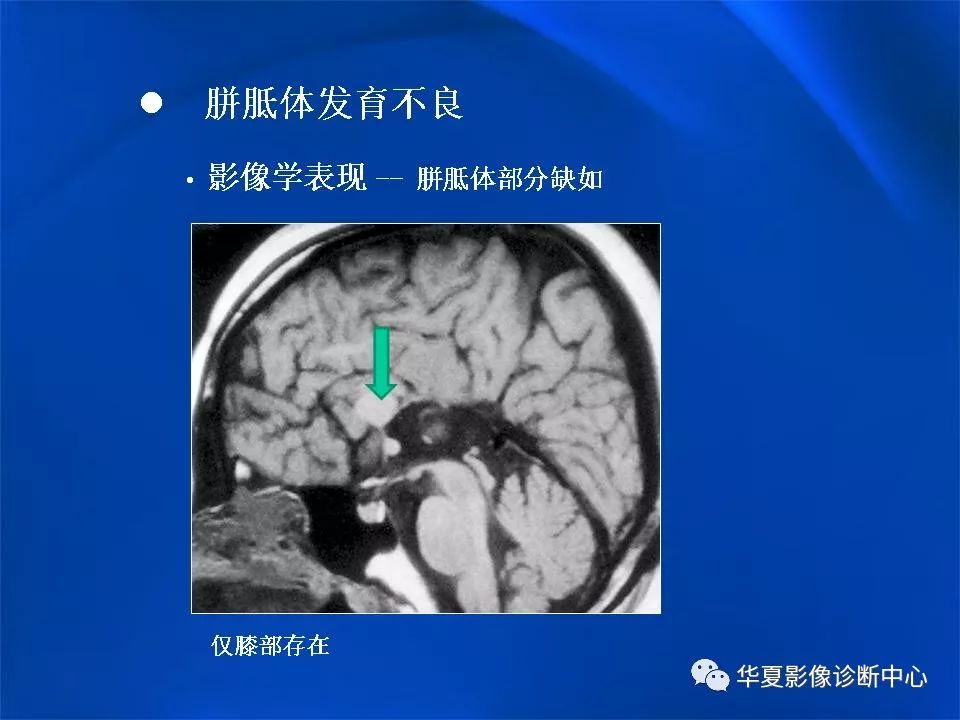 胼胝体解剖及各种病变的影像学表现