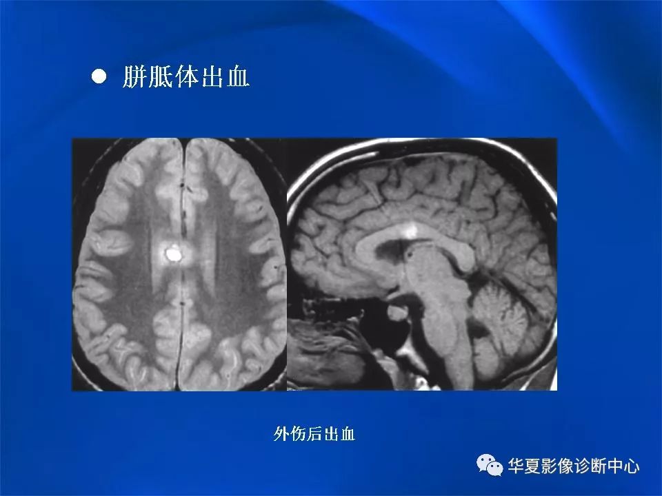 胼胝体解剖及各种病变的影像学表现