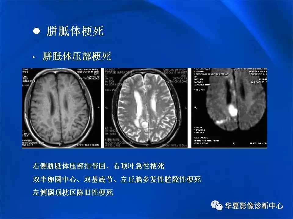 胼胝体解剖及各种病变的影像学表现