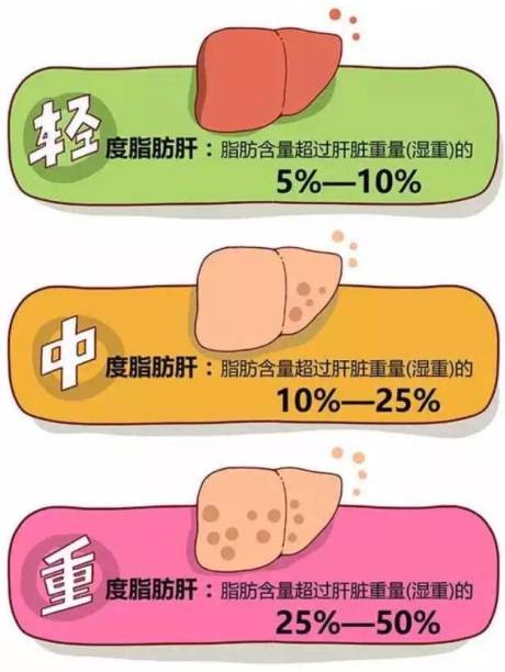 警惕"中年油腻",如何科学治疗脂肪肝?