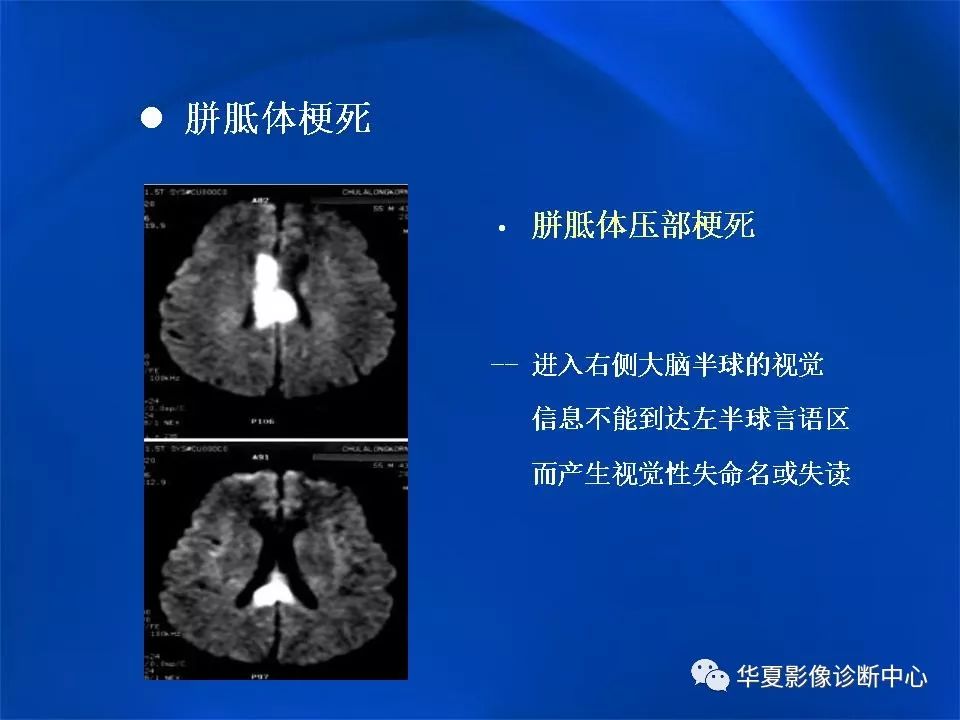 胼胝体解剖及各种病变的影像学表现