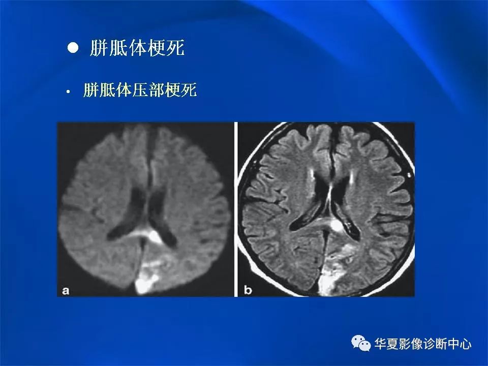 胼胝体解剖及各种病变的影像学表现