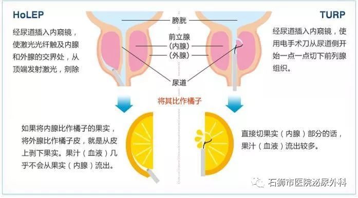 石狮市医院引入精准微创新技术——泌尿外科完成首例经尿道铥激光前列