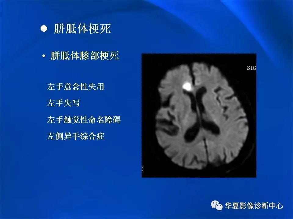 胼胝体解剖及各种病变的影像学表现