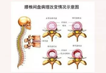 腰疼白疼了:腰椎间盘突出?腰肌劳损?别傻傻分不清楚,耽误治疗