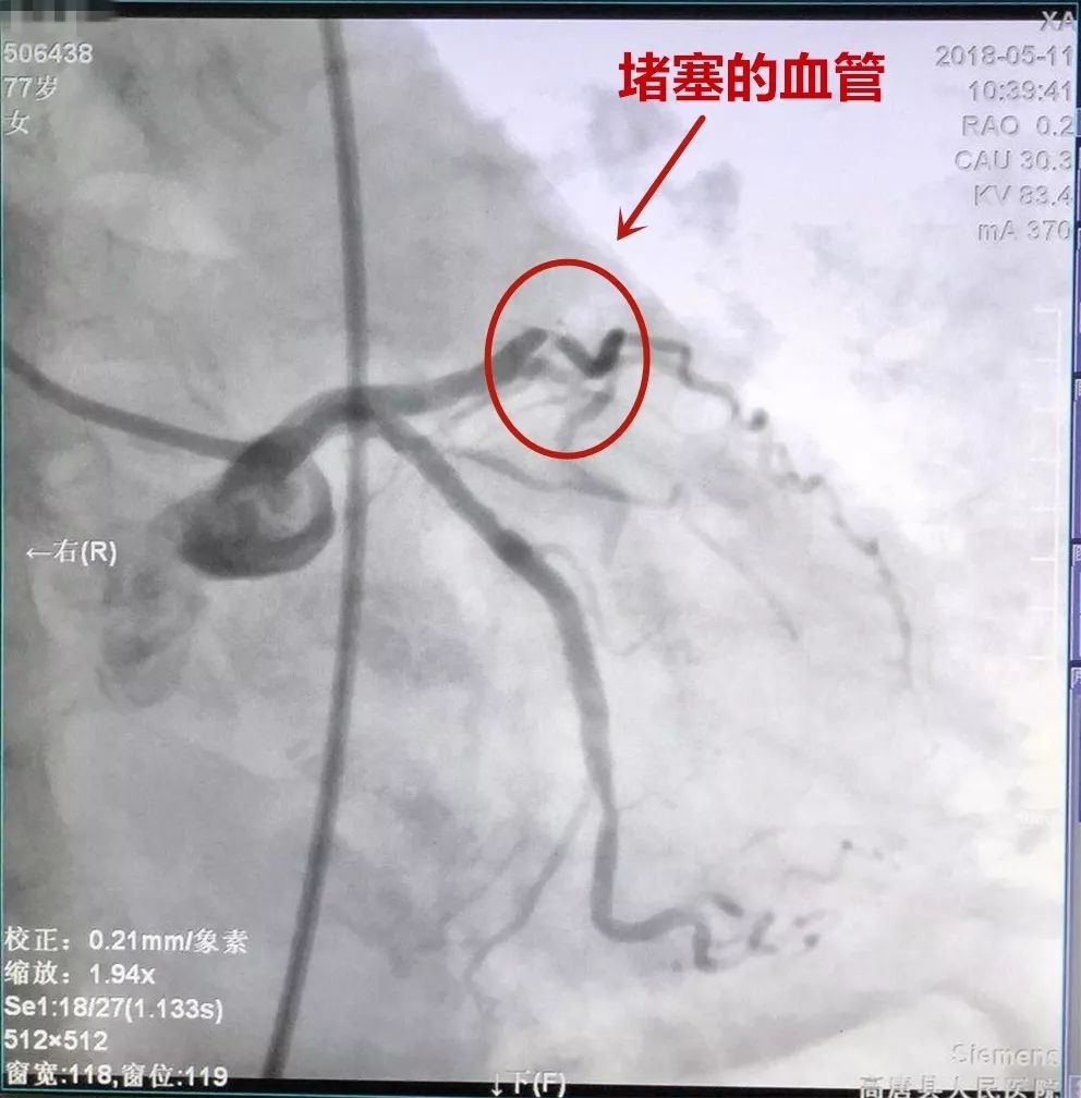 造影显示前降支中段次全闭塞,10:13分开通闭塞血管,患者转危为安.