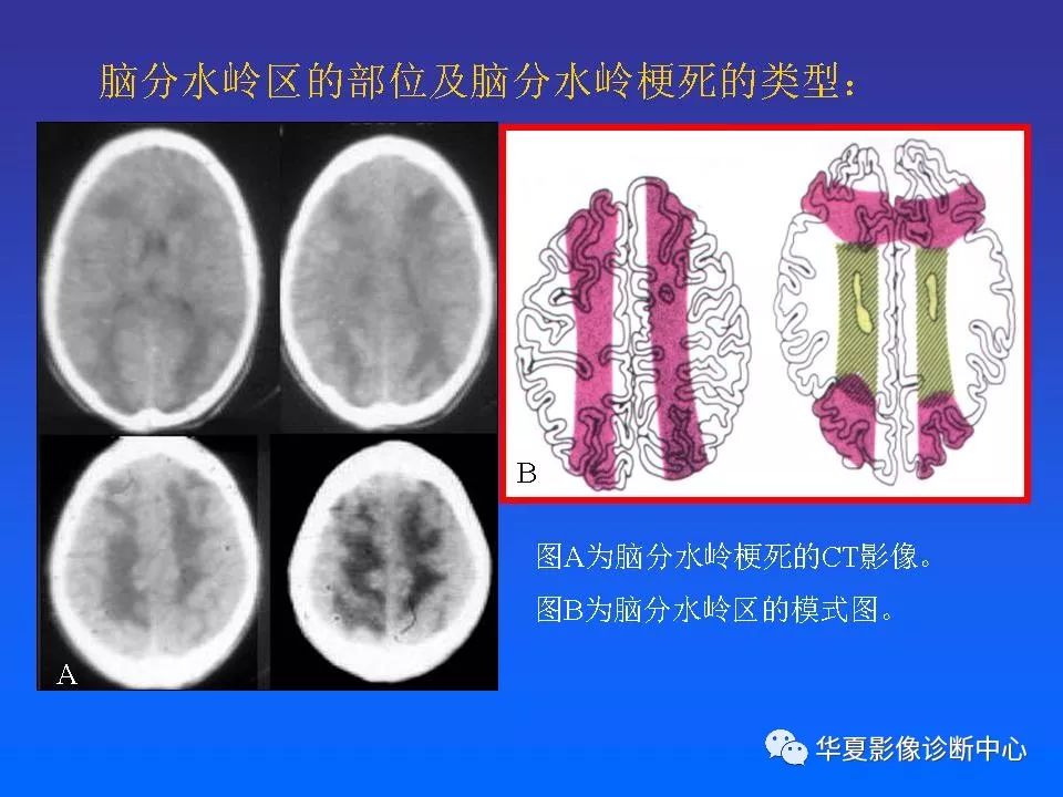 解读分水岭区脑梗死