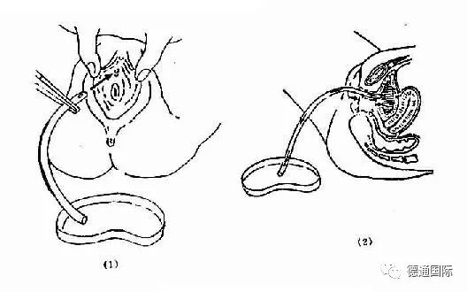 7打开导尿包; 8戴无菌手套,铺洞巾 9整理用物,润滑尿管 10再次消毒
