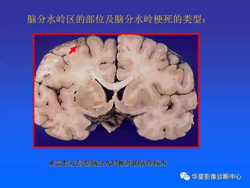 解读分水岭区脑梗死