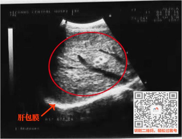 后b超特点:大小不等的结节,肝脏缩小病史:长期大量饮酒,肝炎病史 肝