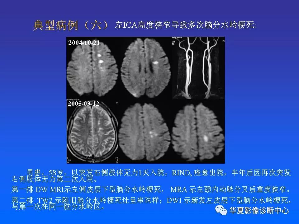 解读分水岭区脑梗死