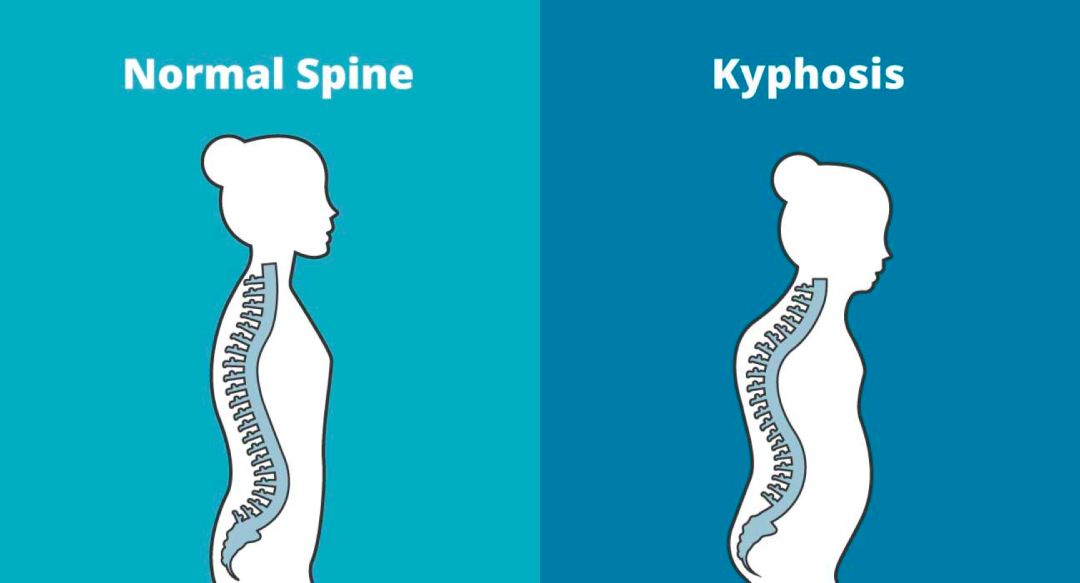 我们经常说的圆肩驼背,到底是怎样的呢?