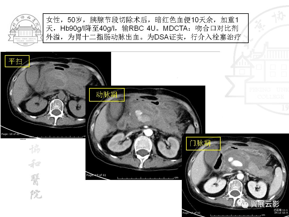 多排螺旋ct对消化道出血临床诊治流程的指导意义