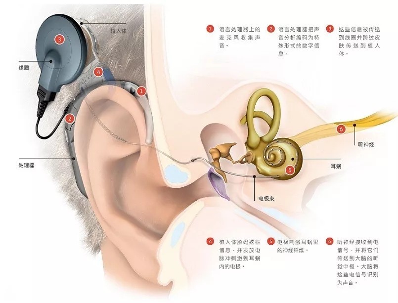 人工耳蜗是一种医疗电子装置,适用于重度和极重度感音神经性耳聋患者