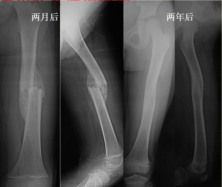 创伤:天津医院小儿骨科0-14岁股骨干骨折治疗方法