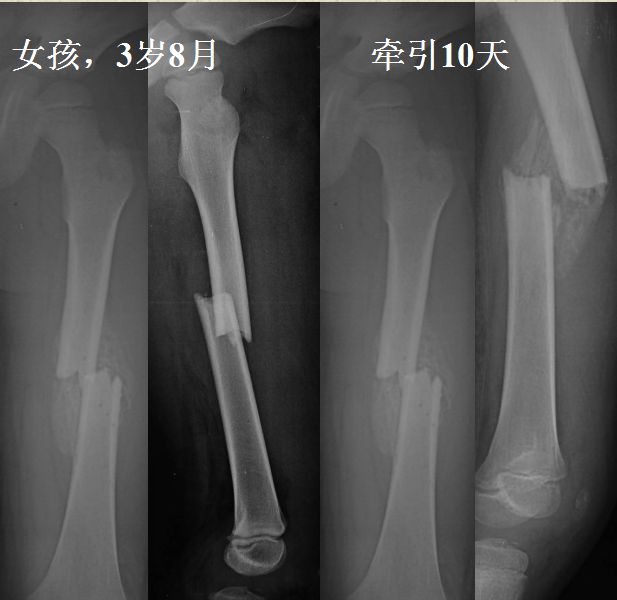 创伤天津医院小儿骨科014岁股骨干骨折治疗方法