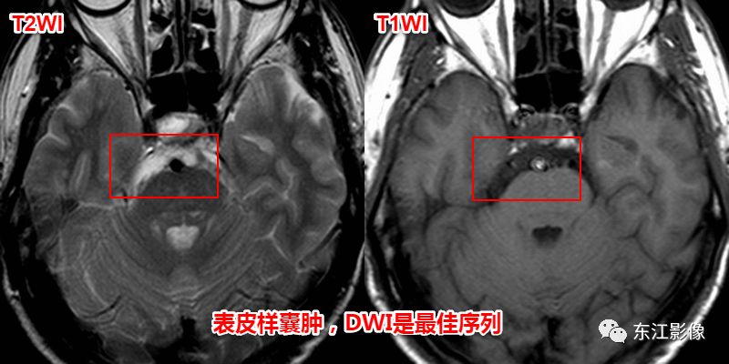 头颅mri入门系列之认识序列3