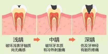 蛀牙有牙洞,到底是补还是拔?看了才知道