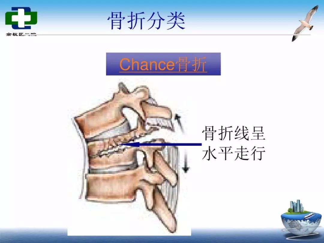 腰椎爆裂性骨折护理查房