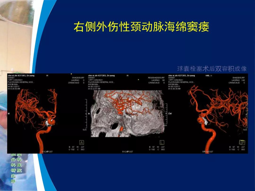 39年前开创复合手术治愈颅底高位颈内动静脉瘘随访报告