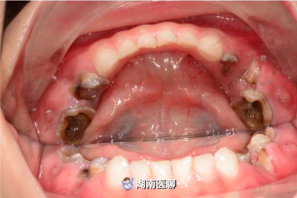 人口腔上牙重要还是下牙重要_重要通知图片(2)