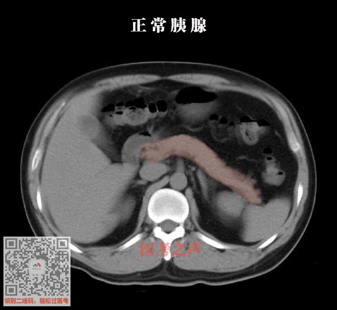 健康 正文  急性水肿型胰腺炎,胰腺癌改变较小 诊断需结合临床表现和