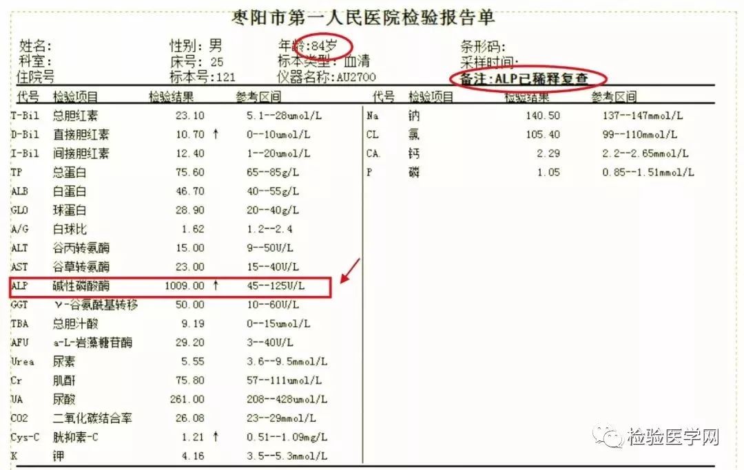 有中老年女性不明原因碱性磷酸酶升高终确诊为原发性胆汁性肝硬化的