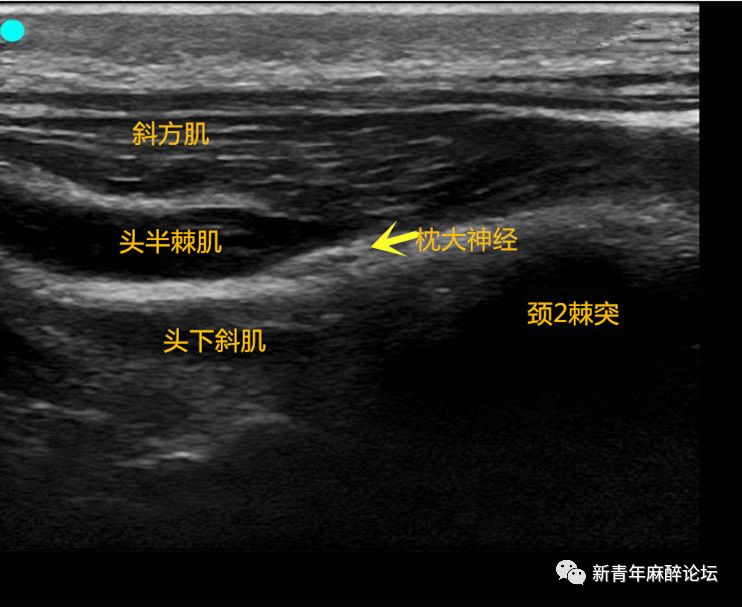 手把手教你超声引导下枕大神经阻滞