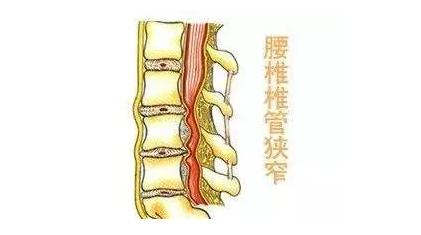 椎间盘膨隆突出,骨性退变导致的腰椎中央管,神经根管或侧隐窝狭窄引起