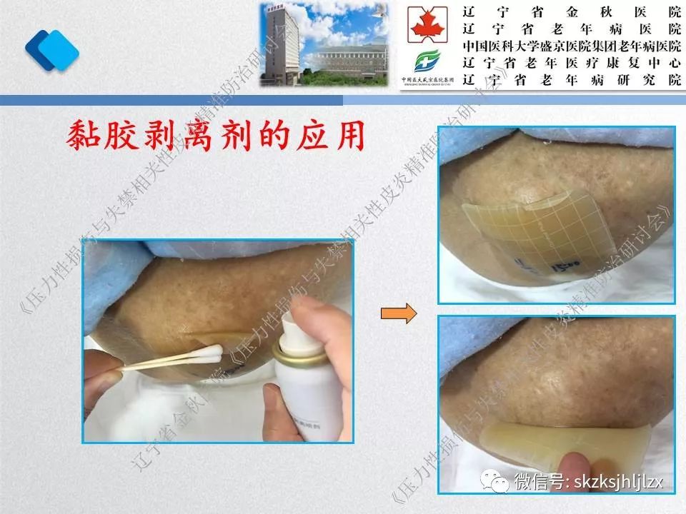 医用黏胶相关皮肤损伤及皮肤撕裂伤的防治进展