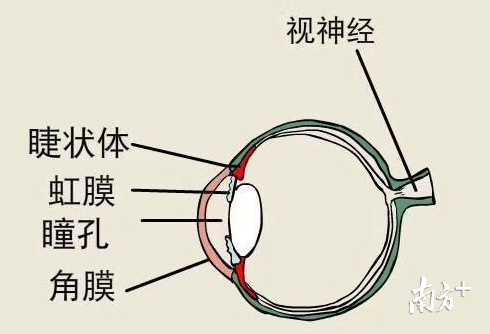 老人头痛多年找不到原因罪魁祸首竟是青光眼