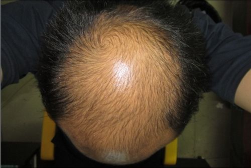 健康 正文  脂溢性脱发的根本原因是头顶上的毛囊存在结构上的先天性