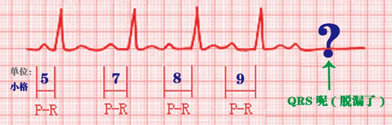 太晚干脆就不回来了 心电图: 特点: pr间期恒定(正常或延长) 但qrs