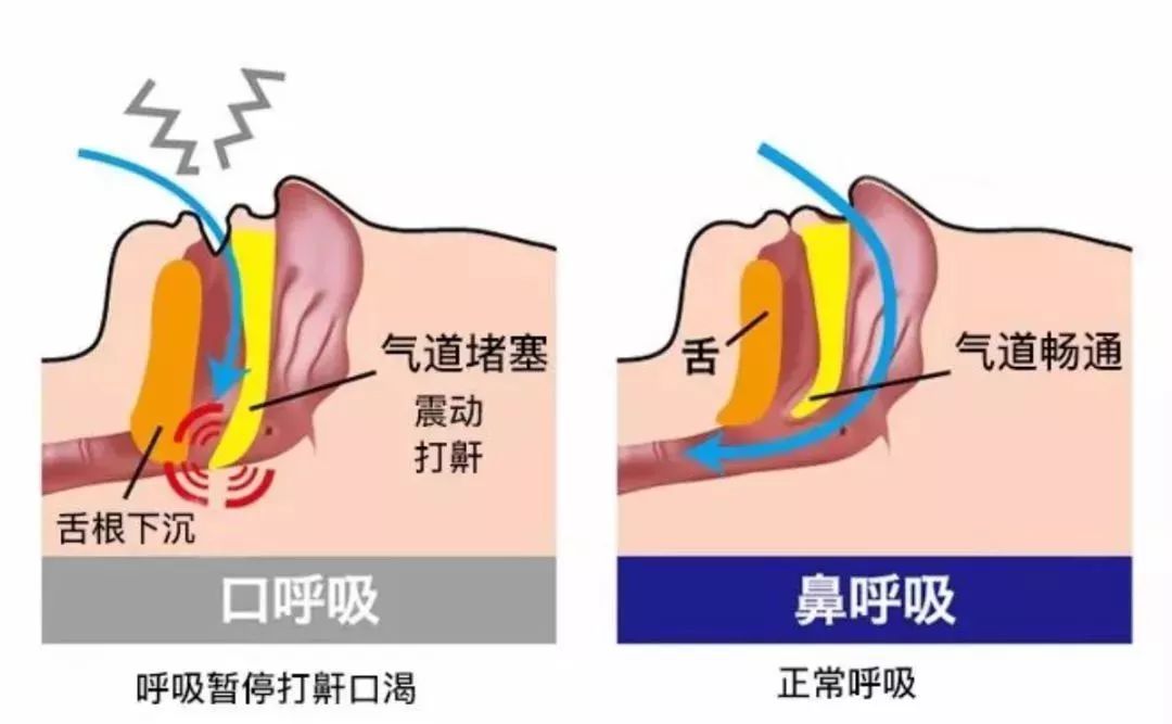 鼾症的主要原因是腺样体肥大 或扁桃体肥大也有两者共同导致的打鼾