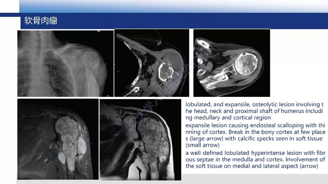 【每日一例| 602例】女,右肱骨近端肿瘤8月
