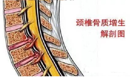 脊椎综合征的病理改变