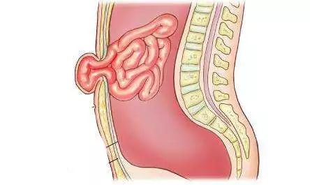 你的肚脐怎么凸起来了?脐疝来了解一下