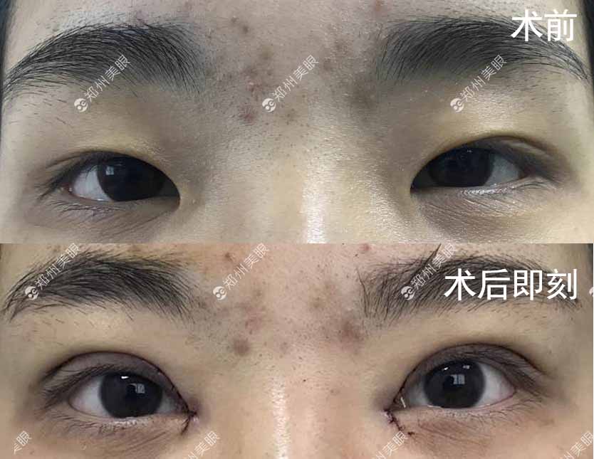 想开眼角怕失败怎么办?哪里开眼角好?