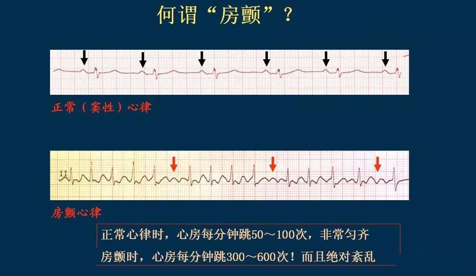 房颤知识