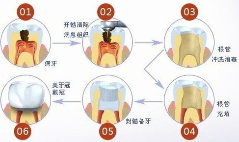 健康 正文  05 根管治疗术后,必须对破损牙冠进行修复,大多数情况下