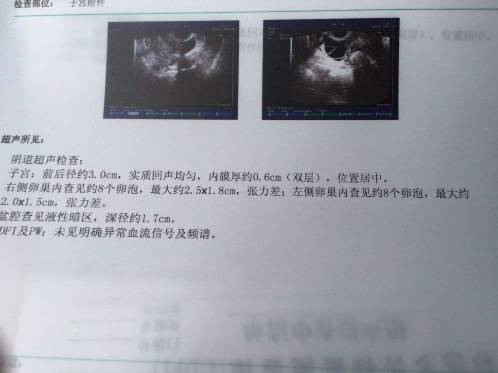 多囊卵巢综合征患者该如何备孕?