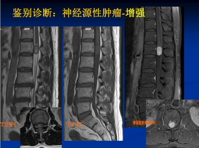 腰椎间盘突出症的影像学诊断和治疗