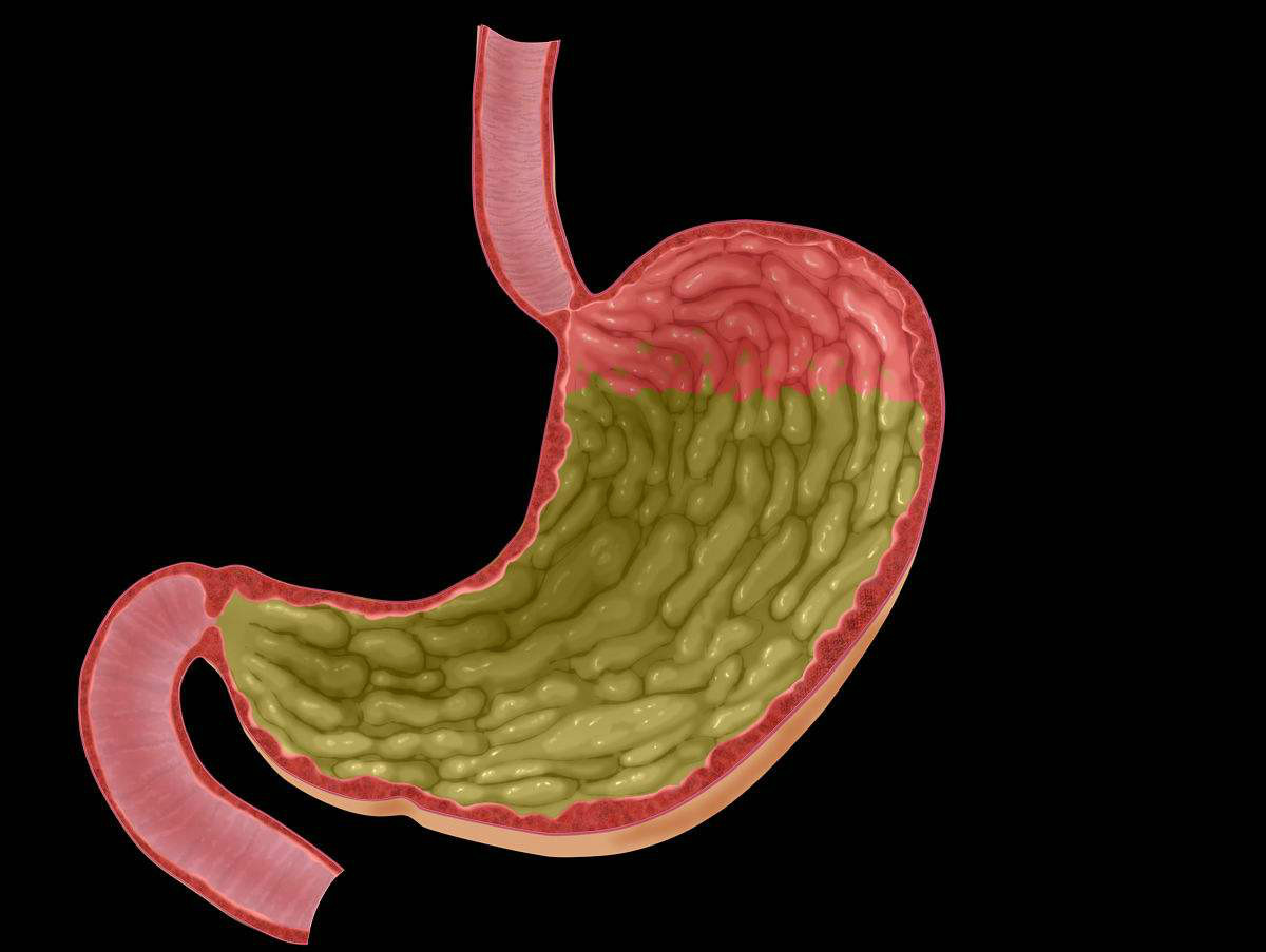 无痛胃镜能发现四种早期胃病,但医生却说三类人一定不