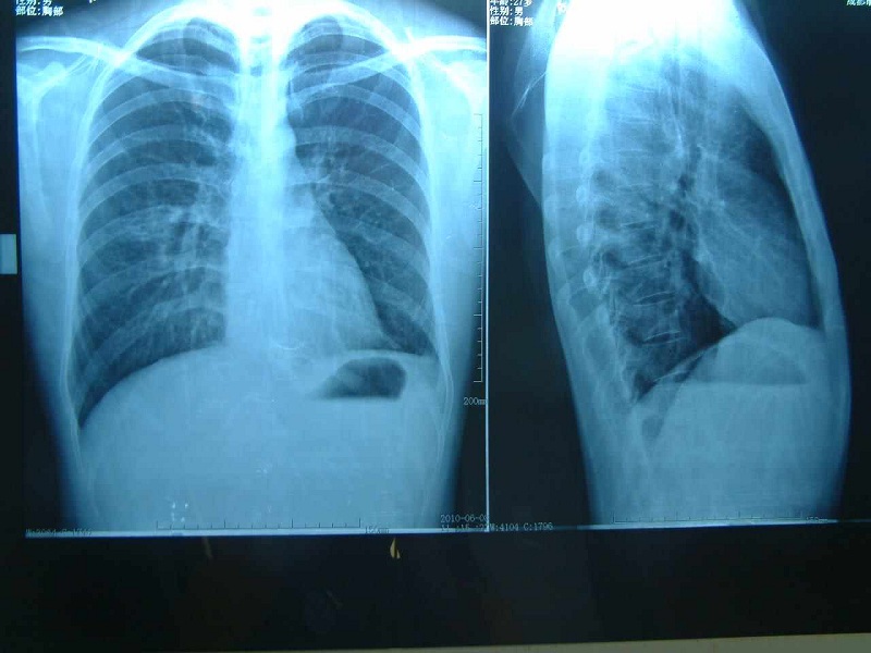 肺结核患者病灶中出现了钙化意味着什么,居然对于排除肺癌有帮助