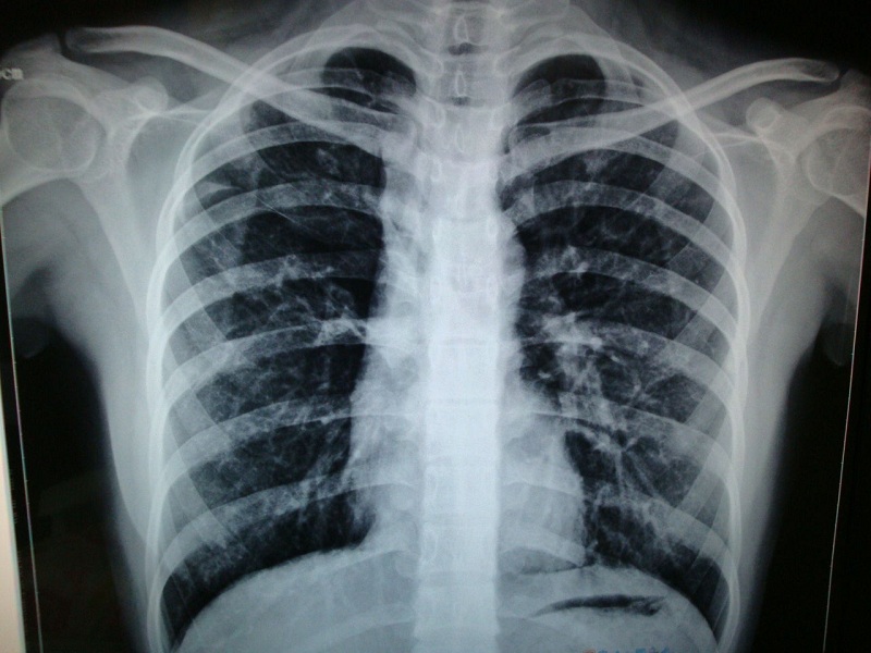 肺结核患者病灶中出现了钙化意味着什么,居然对于排除