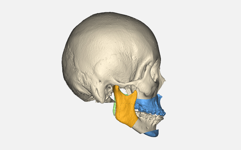 三维可视化技术推动颅颌面外科手术精准化